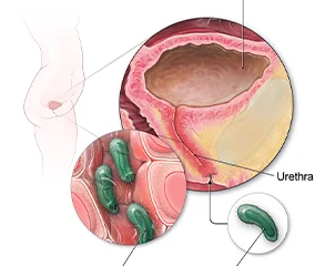 Treatment of Urinary Tract Infections